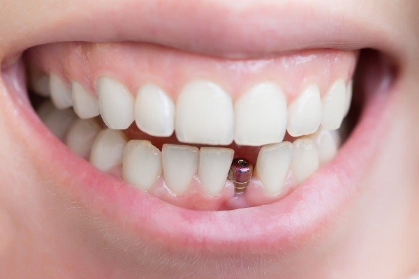 تفاوت بین پروتز دندان و ایمپلنت