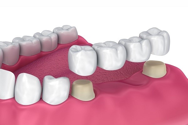 پروتز دندان چیست؟
