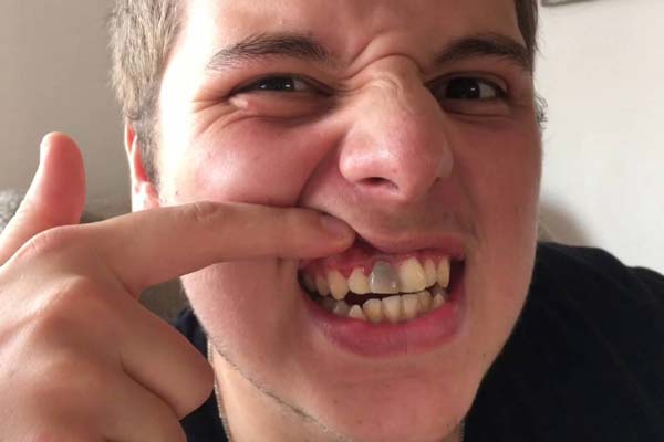سیاه شدن دندان عصب کشی شده