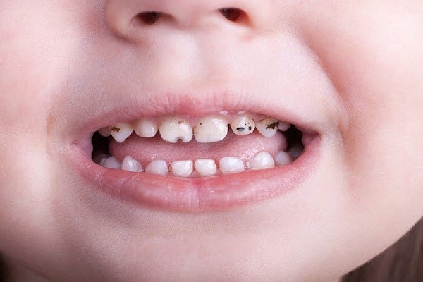علت سیاه شدن دندان ها